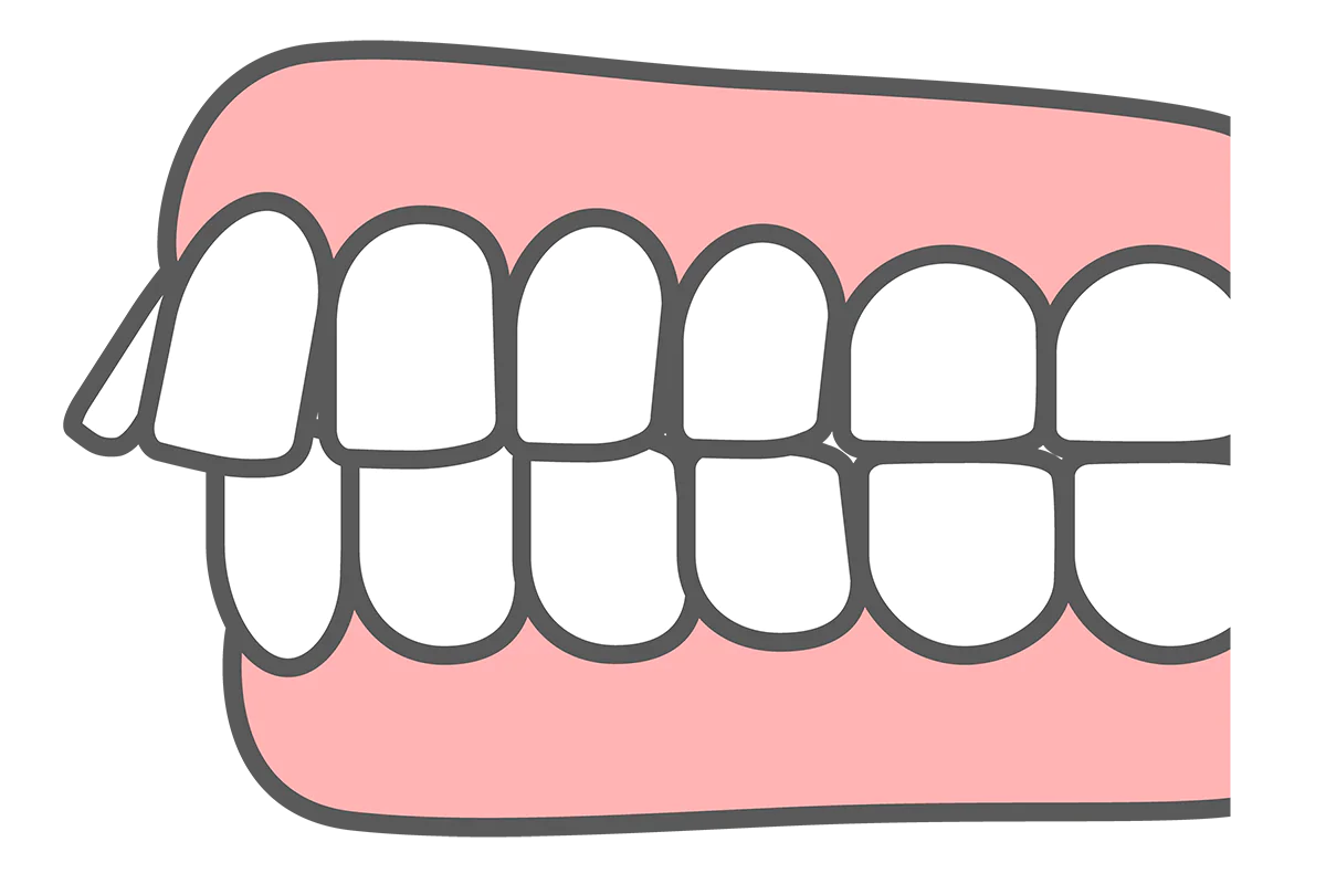 出っ歯(口ゴボ)の原因と治療方法