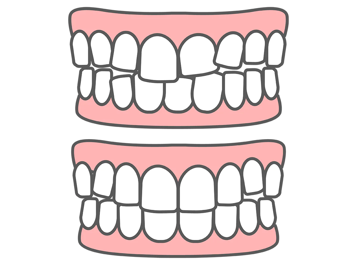 叢生(歯がデコボコ・八重歯)の原因と治療方法