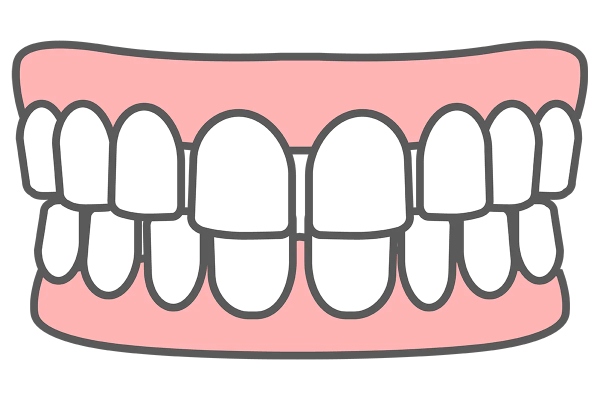 すきっ歯(空隙歯列)の原因と治療方法